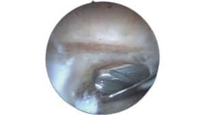 arthrose acromio claviculaire chirurgie de l'épaule paris docteur thomas waitzenegger chirurgie epaule chirurgie main chirurgie coude paris 16
