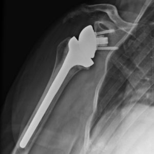 fractures epaule urgences epaule paris docteur thomas waitzenegger chirurgie epaule chirurgie main chirurgie coude paris 16 longjumeau