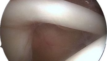 acromioplastie arthroscopie tendinite longue portion biceps chirurgie de l epaule paris docteur thomas waitzenegger chirurgie epaule chirurgie main chirurgie coude paris 16 longjumeau