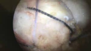 arthroscopie suture tendons coiffe rotateurs rupture calcification chirurgie de l epaule paris docteur thomas waitzenegger chirurgie epaule chirurgie main chirurgie coude paris 16 longjumeau 1