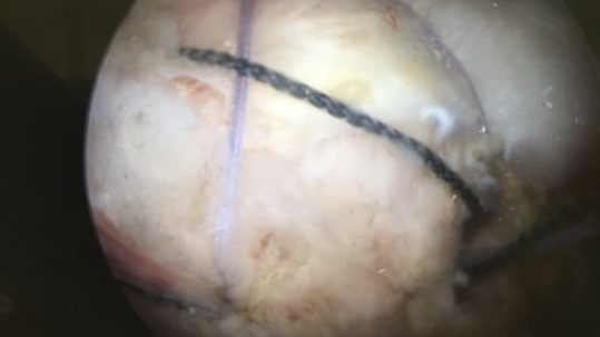 arthroscopie suture tendons coiffe rotateurs rupture calcification chirurgie de l epaule paris docteur thomas waitzenegger chirurgie epaule chirurgie main chirurgie coude paris 16 longjumeau 1