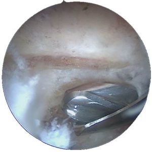 arthrose acromio claviculaire chirurgie de l epaule paris docteur thomas waitzenegger chirurgie epaule paris 16 longjumeau