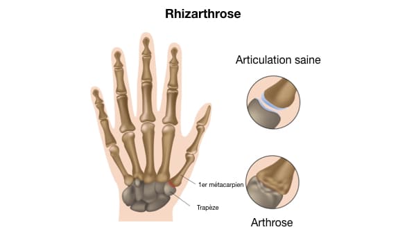 rhizarthrose pouce rhizarthrose traitement arthrose du pouce docteur thomas waitzenegger chirurgien de la main paris 16