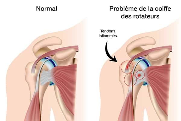 rupture coiffe des rotateurs operation epaule athroscopie docteur thomas waitzenegger chirurgien orthopediste epaule paris chirurgien orthopediste main paris