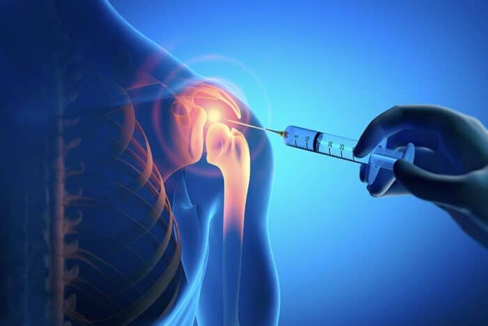 soulager rhizarthrose infiltration acide hyaluronique specialiste chirurgien epaule dr thomas waitzenegger paris